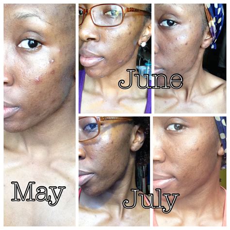 Banish Acne Scars Review — Glitz And Glam By Tiff Fashion And Lifestyle
