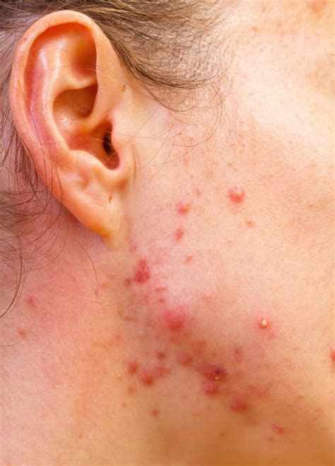 What Are The Most Common Causes Of Skin Lesions