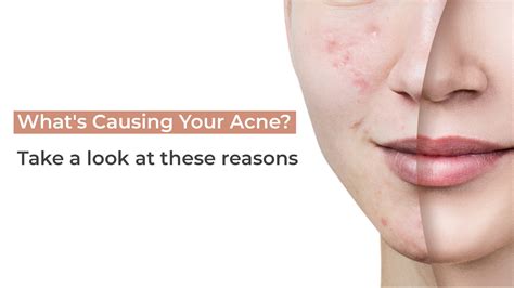 Whats Causing Your Acne Take A Look At These Reasons Suganda Skincare