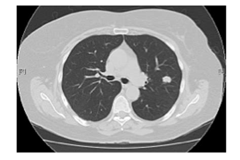 What Does Lung Scarring Look Like On Ct Scan Ct Scan Machine
