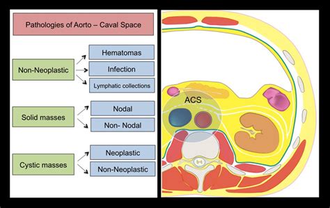 Classification Of Aorto Caval Space Acs Pathology Download