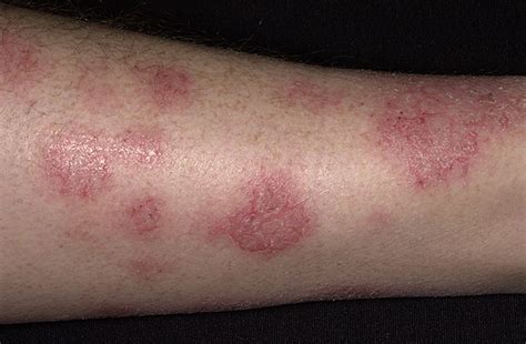 Eczema Dermatite Eczematosa
