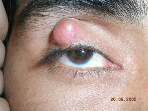 Pimple On Eyelid Types Causes And How To Treat Them