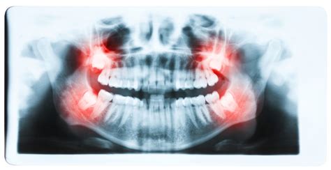Three Treatment Options For A Wisdom Tooth Infection Wisdom Teeth Dental Implants