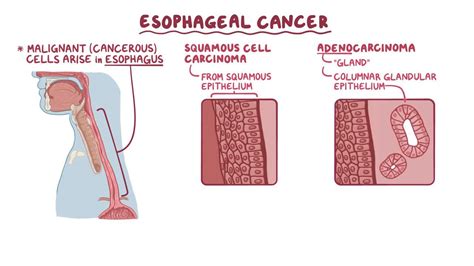 Esophageal Cancer Video Anatomy Definition Osmosis