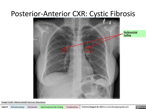 Read about the symptoms, causes and treatments. Cystic Fibrosis: Posterior-Anterior Chest X-Ray | Calgary ...