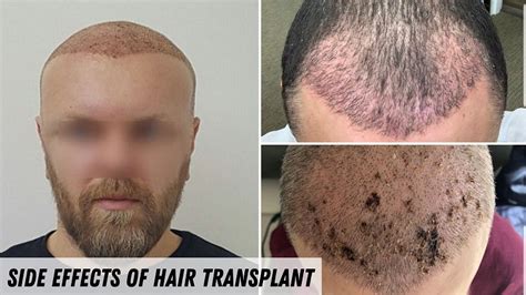 Side Effects Of Hair Transplant What To Expect How To Prevent Them