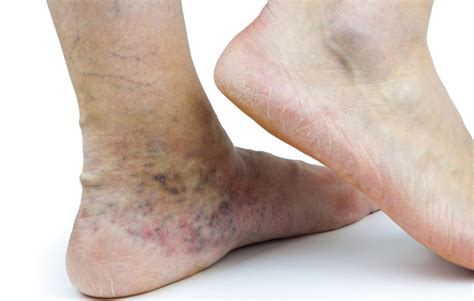 Pictures Of Varicose Veins In Feet Symptoms And Pictures