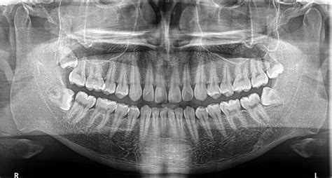Dr Mogre Oral Facial Surgery Blog Impacted Wisdom Teeth What Is The