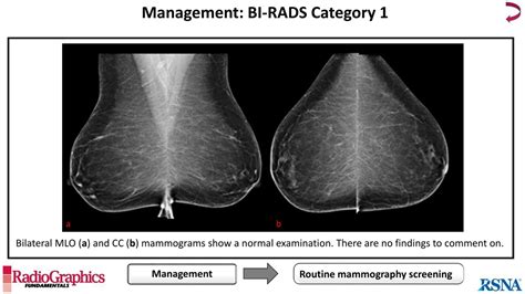 Ppt Bi Rads Terminology For Mammography Reports What Residents Need