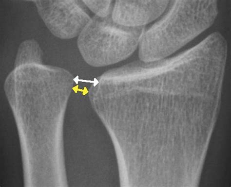 Distal Radioulnar Joint Stress Radiography For Detecting Radioulnar Ligament Injury Semantic