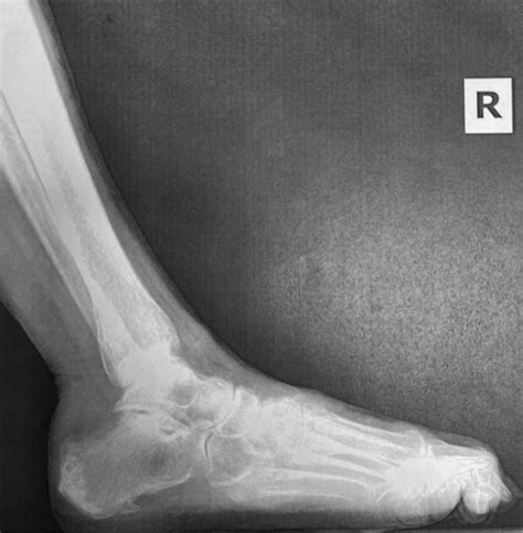 Right Foot X Ray Presentation Post Operation Download Scientific Diagram