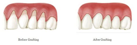 Gum Grafting Procedure 101 — Emergency Dental Columbus Ohio
