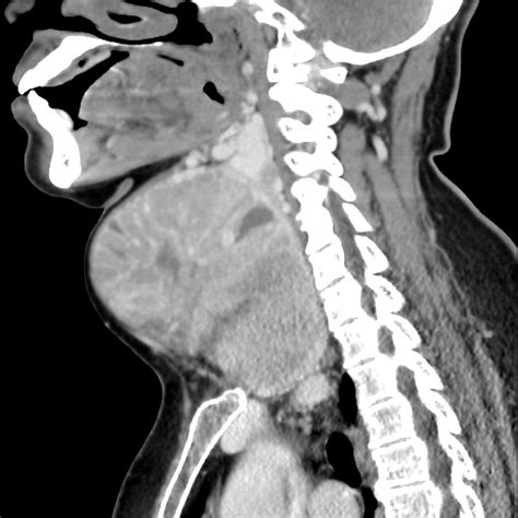 Multinodular Goiter Pacs