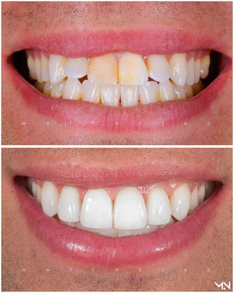 Cosmetic Smile Makeover With 6 Porcelain Veneers To Correct Flared