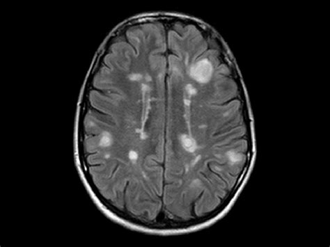Mri Scan Of The Brain In A Patient With Multiple Sclerosis Showing