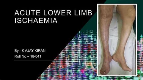 Acute Limb Ischemia Surgical Managementpptx