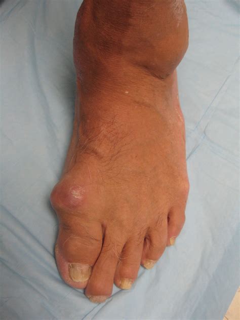 Hallux Rigidus Dominic Carreira Md Hip Arthroscopy And Foot And Ankle