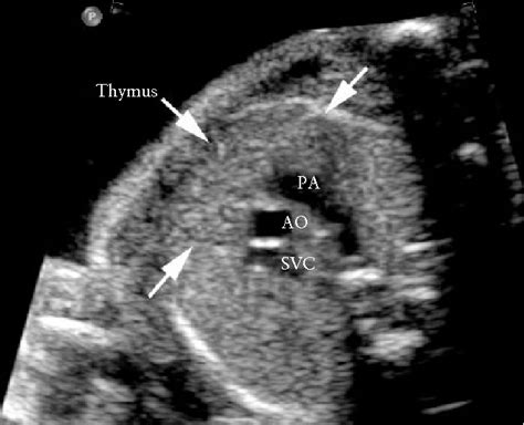 Figure 1 From Assessment Of The Fetal Thymus By Two And Three