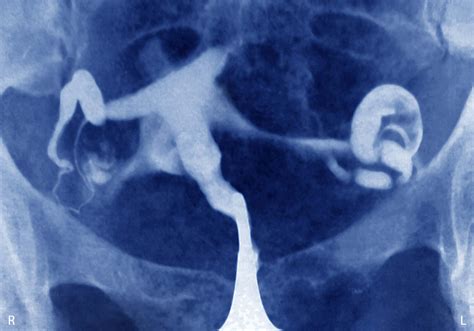 Methotrexate Injection For Ectopic Pregnancy