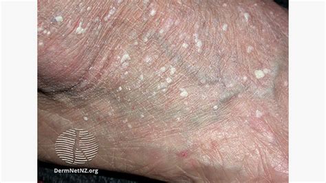 Stucco Keratosis Definition Causes Treatment