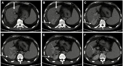 Abdominal Axial Contrast Enhanced Computed Tomography Scans In The