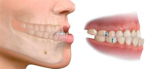 Tratamiento para la mandíbula desencajada o dislocada Abaden dentistas