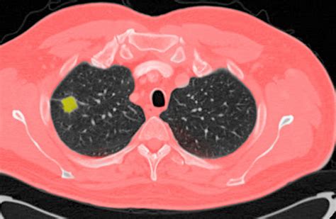 Lung Nodule Evaluation Guideline Adherence Is High In Multidisciplinary