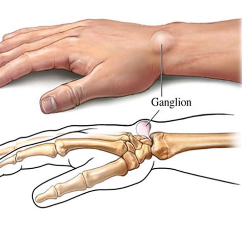 Ganglion Cysts Orthopaedic Center Of Southern Illinois