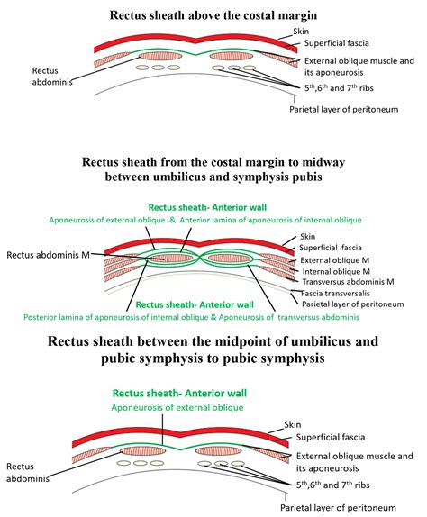 Rectus Sheath Formation Contents Abdominal Incisions Anatomy Qa