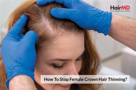 How To Stop Female Crown Hair Thinning