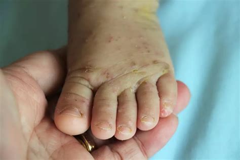 Scabies Rash Treatment Wedding Ideas You Have Never Seen Before