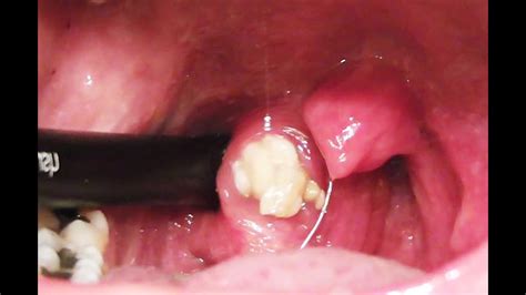 Tonsil Stones Giant Tonsilloliths Stone Removal