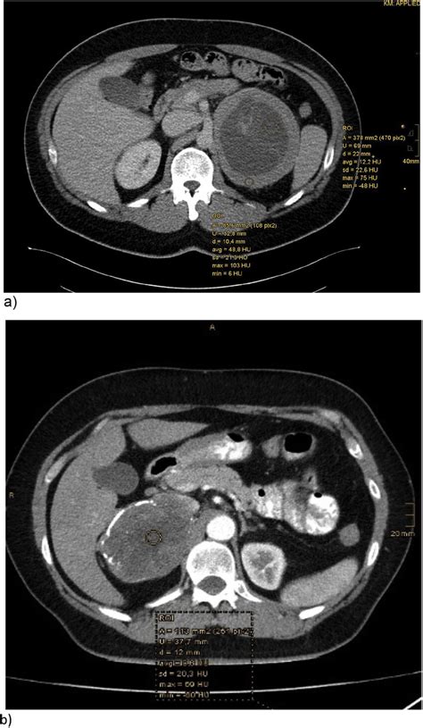 Contrast Enhanced Ct Scans Of Both Patients A Male Patient With A