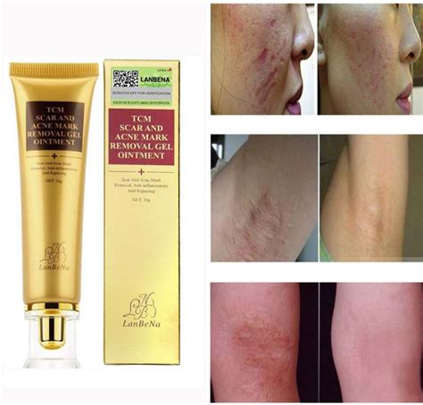 Symeas Scar Acnes Vergetures Acne Scar Removal Cream Acnés Scar Keloid