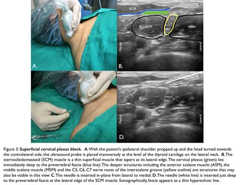 Ultrasound Guided Femoral Nerve Block Nysora Nysora