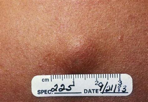 Benign Cysts Under Skin Dorothee Padraig South West Skin