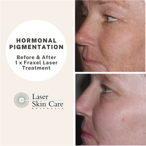 Hormonal Pigmentation Laser Skin Care