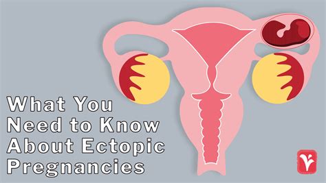 Texas Ectopic Pregnancy Diagnosis And Treatment Austin Womens Health