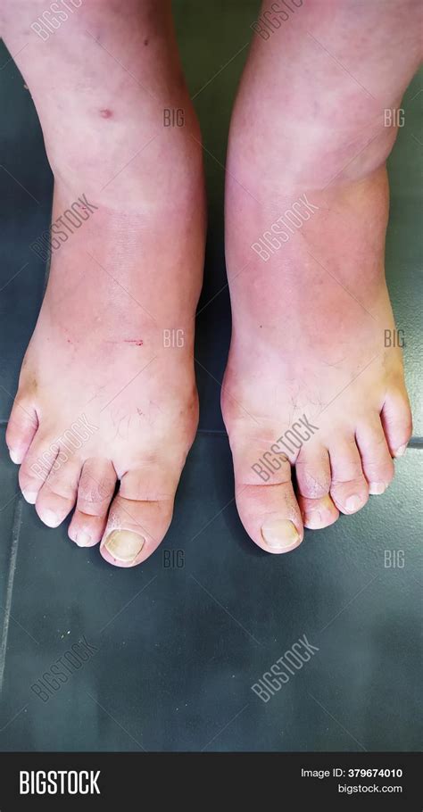 Swollen Feet Blood Image And Photo Free Trial Bigstock