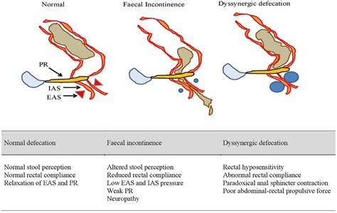 Fecal Incontinence