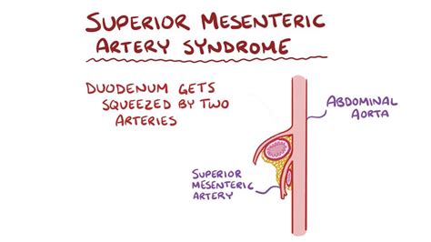 superior mesenteric artery syndrome video and anatomy osmosis