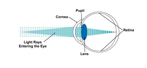 Understanding Your Vision And Cataracts Ic 8 Lens