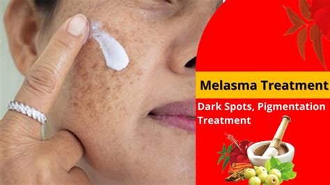 What Is Treatment Of Melasma And Skin Problems Melasma झाइयां हटाने का सही तरीका Dr