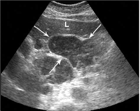 Imaging Of Kimura S Disease Involving The Abdomen Ajr