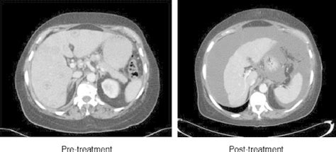 8post Treatment Ct Shows A Small Liver With Nodular Contour On A