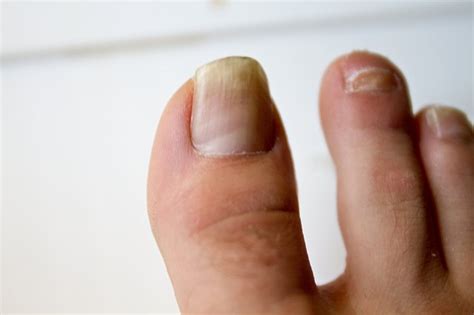 Once the skin is treated, however, the nails may. How to Use Rubbing Alcohol to Kill Nail Fungus | LEAFtv