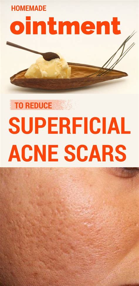 Homemade Ointment To Reduce Superficial Acne Scars Fitness Fiesta