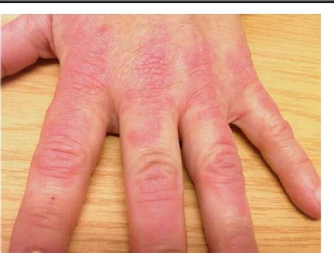 Fig A Photograph Showing The Left Hand Of The Patient With A Rash