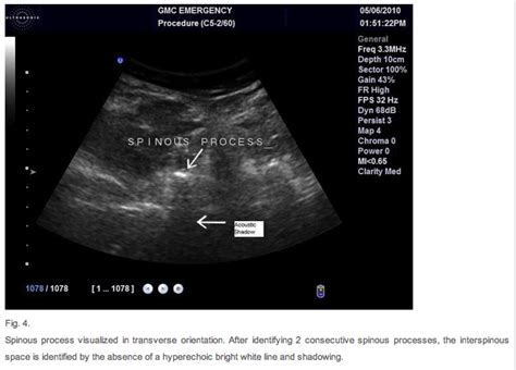 Ultrasound For Lumbar Puncture How To Maximize First Pass Success In